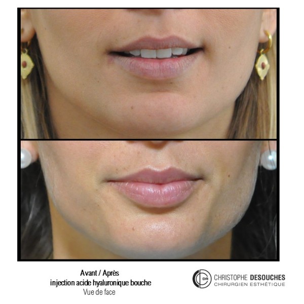 Increase in lip volume by injection of hyaluronic acid