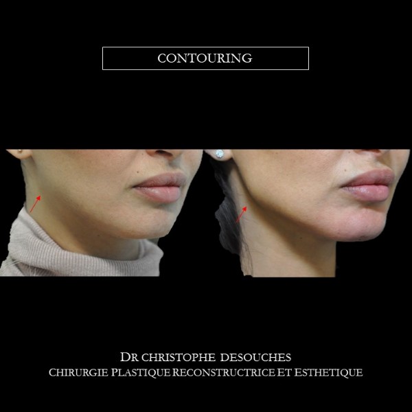 CONTOURING