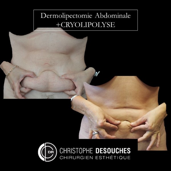 ABDOMINAL DERMOLIPECTOMY AND CRYOTHERAPY