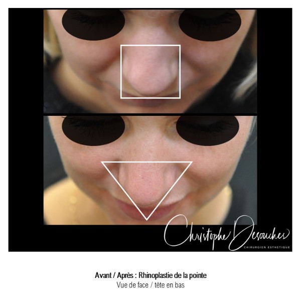 Rhinoplastie de la pointe