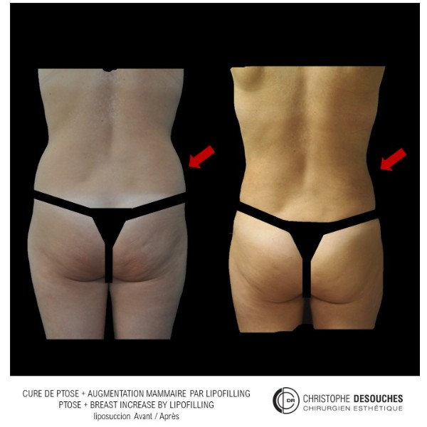 Result of liposuction for lipofilling of the breasts