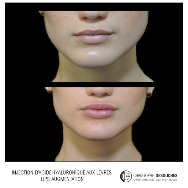 Lips augmentation