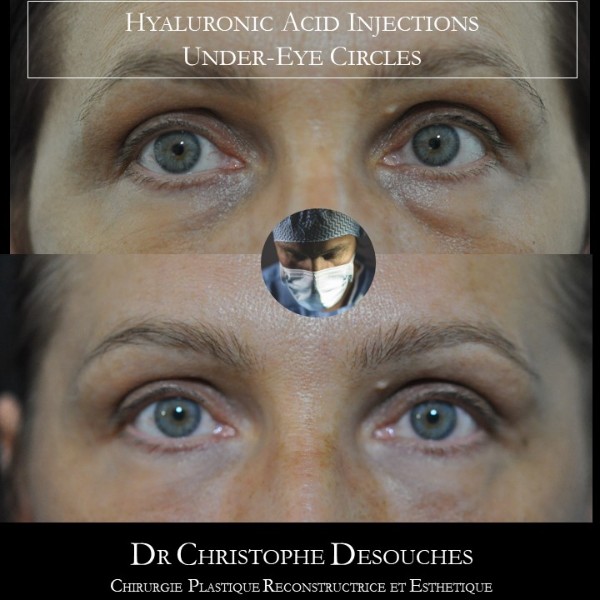 Inyección de ácido hialurónico para armonizar la mirada sin cirugía