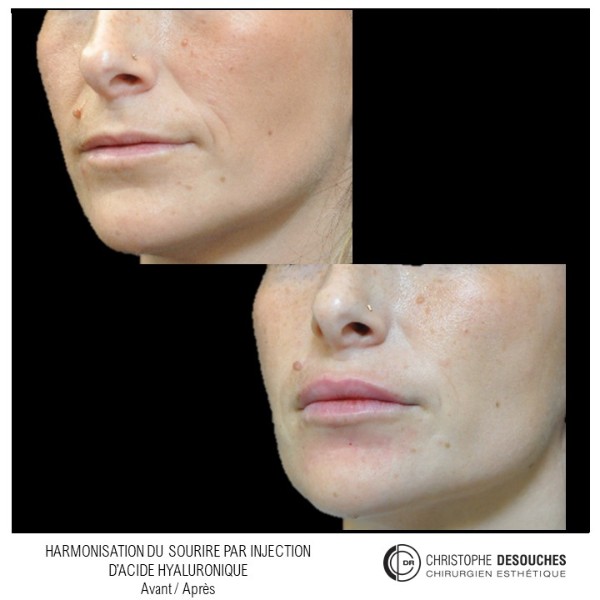 Lip augmentation by injection of Hyaluronic Acid: before / after