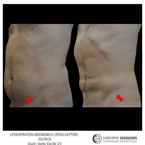 LIPOSUCCION ABDOMINALE