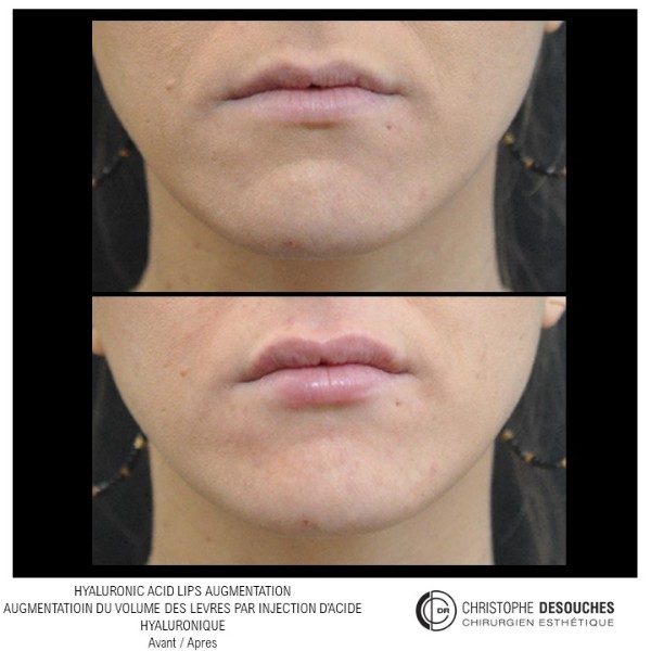 Lips augmentation / augmentation des levres par injection d'acide hyaluronique