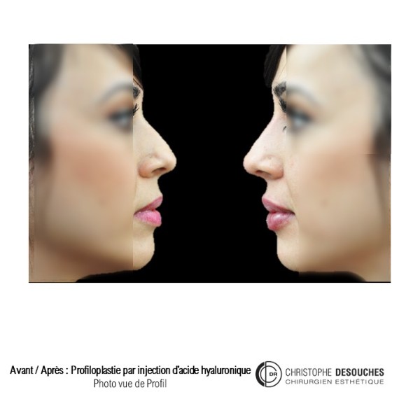 Lip augmentation / lip augmentation by injection of hyaluronic acid