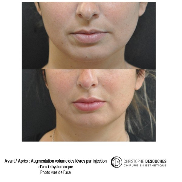 Lip augmentation / lip augmentation by injection of hyaluronic acid