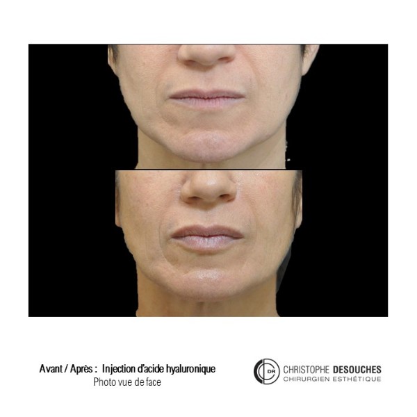 Lip augmentation / lip augmentation by injection of hyaluronic acid