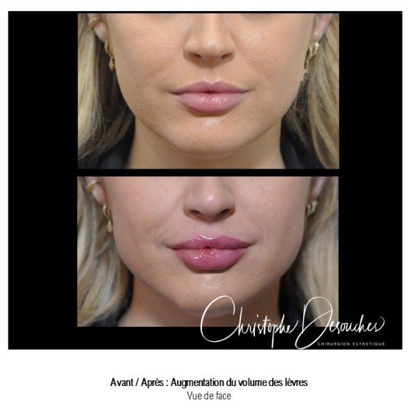 Lip augmentation / lip augmentation by injection of hyaluronic acid