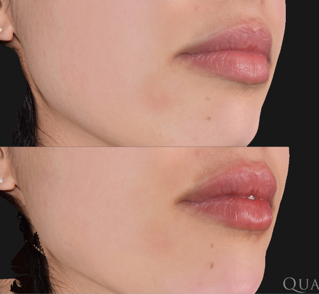 Lip augmentation by injection of Hyaluronic Acid