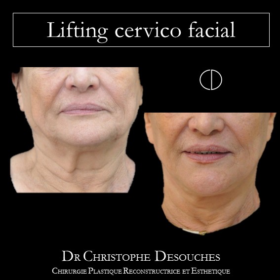 cervico-facial lifting