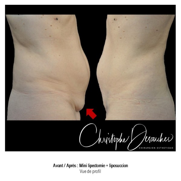 Mini lipectomy & liposuction