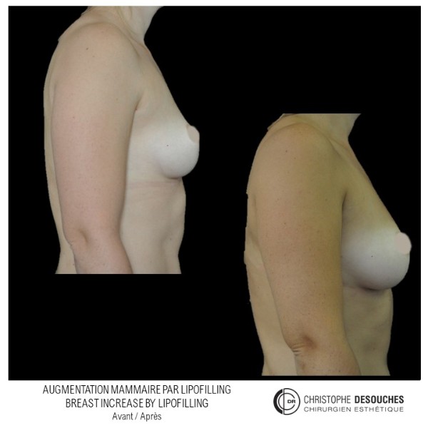 Breast augmentation by lipofilling