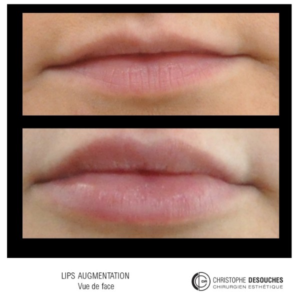 Lip augmentation by injection of Hyaluronic Acid