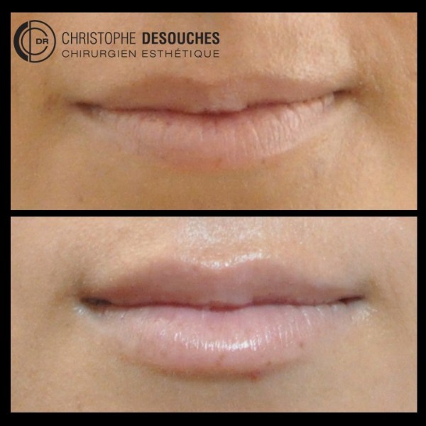 Lips augmentation