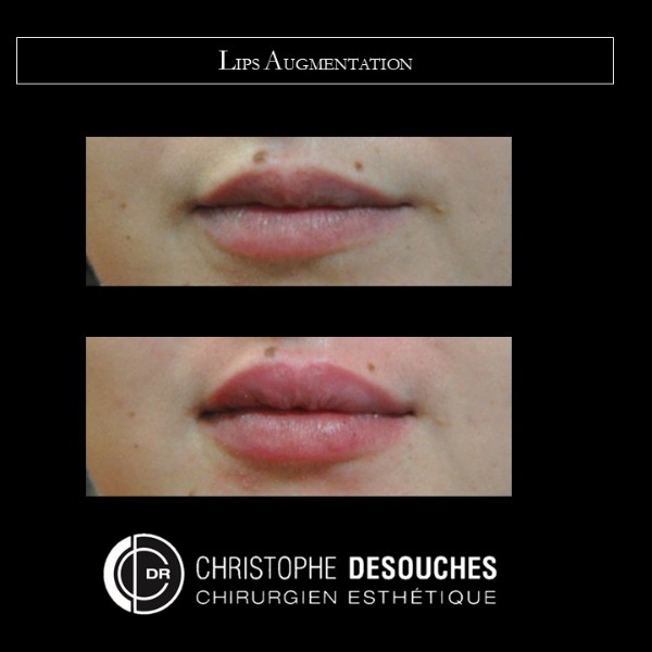 Aumento de labios, labios carnosos, ácido hialurónico, dobladillo rediseñado