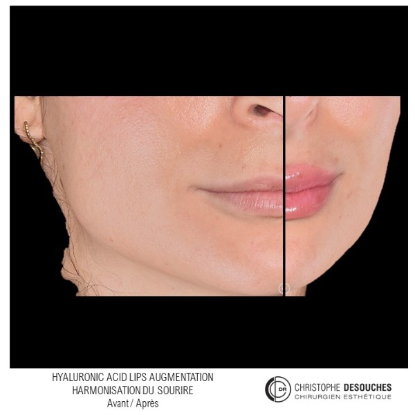 Increase in lip volume by injection of Hyaluronic Acid 