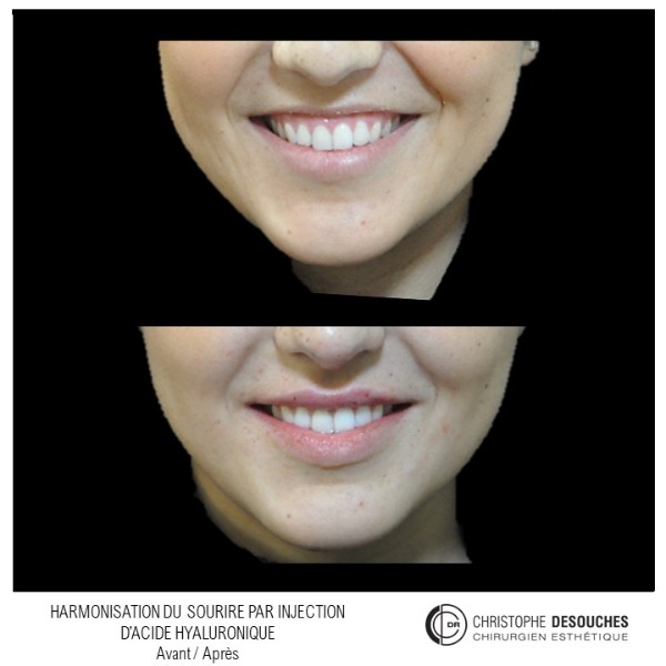Harmonisation du sourire par injection d'acide hyaluronique au niveau des lèvres