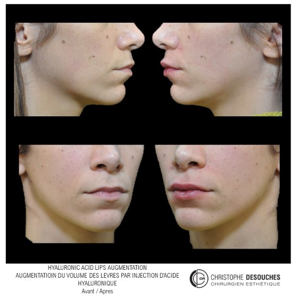 Hyaluronic acid lips augmentation - Lip augmentation