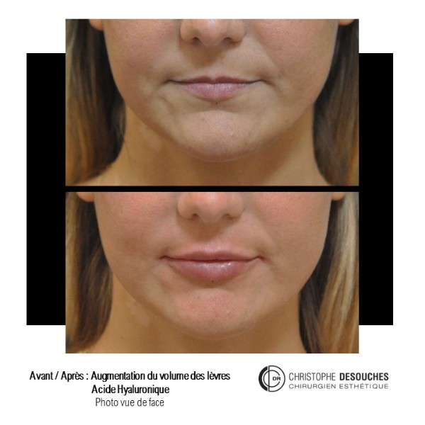 Lip augmentation / lip augmentation by injection of hyaluronic acid