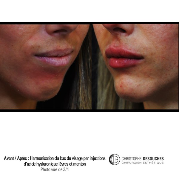 Medical profiloplasty: Lip and chin augmentation 