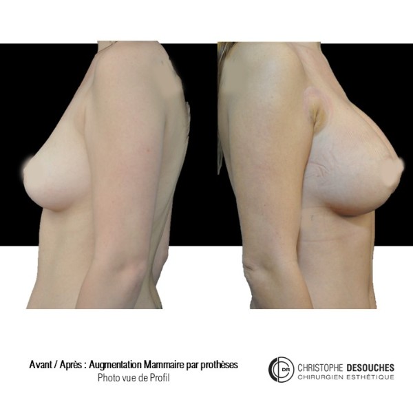 Breast augmentation by prosthesis