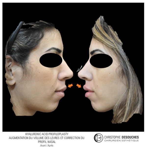 perfiloplastia