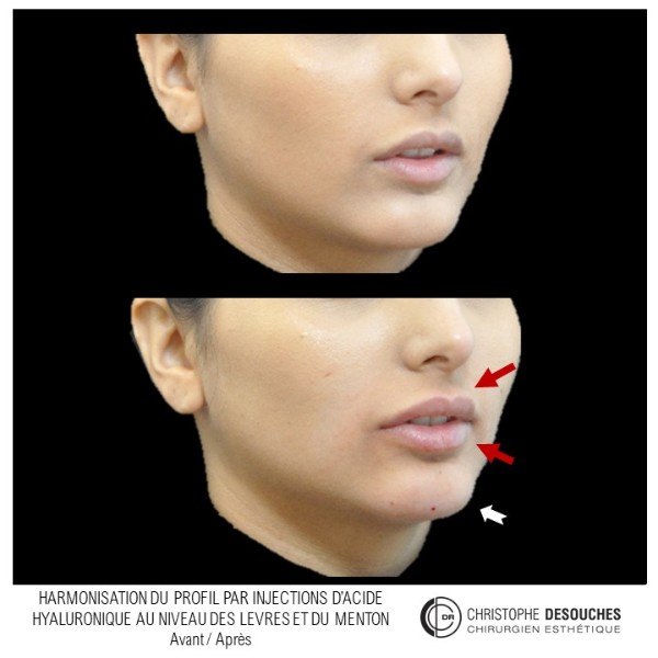 Medical profiloplasty by injection of hyaluronic acid
