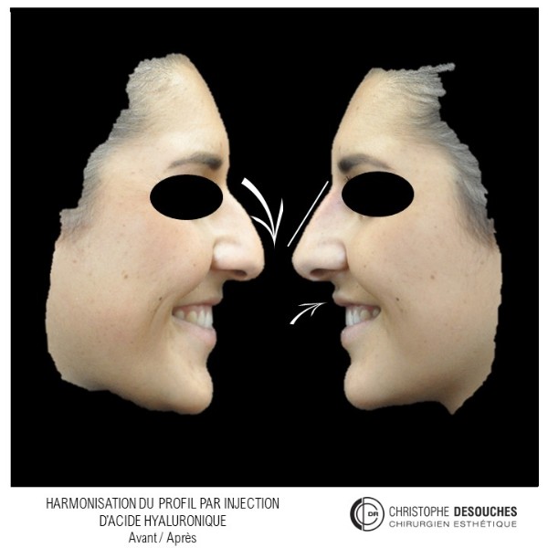 Profiloplasty by injection of hyaluronic acid in the nose and lips