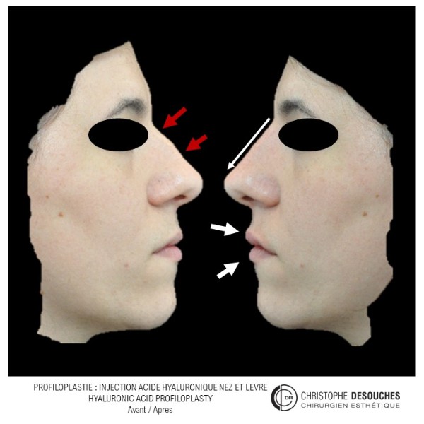 Medical Profiloplasty: the art of harmonizing the profile, without surgery 