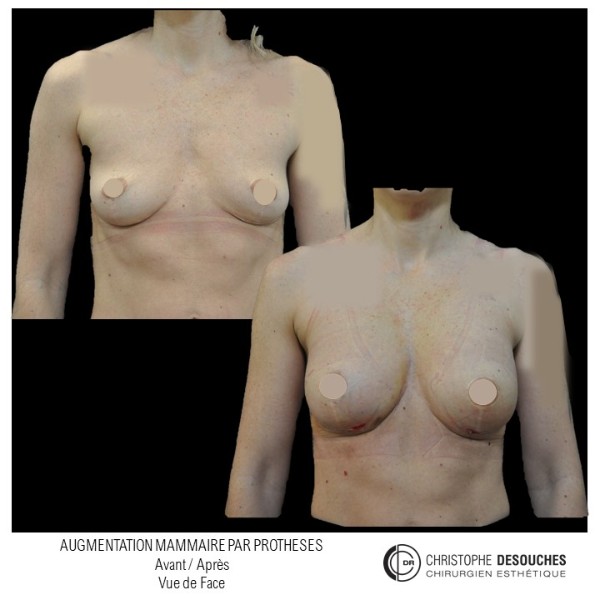 Breast augmentation with prostheses