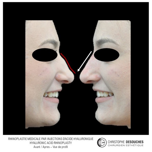 Medical rhinoplasty: injections of hyaluronic acid to correct the nasal profile