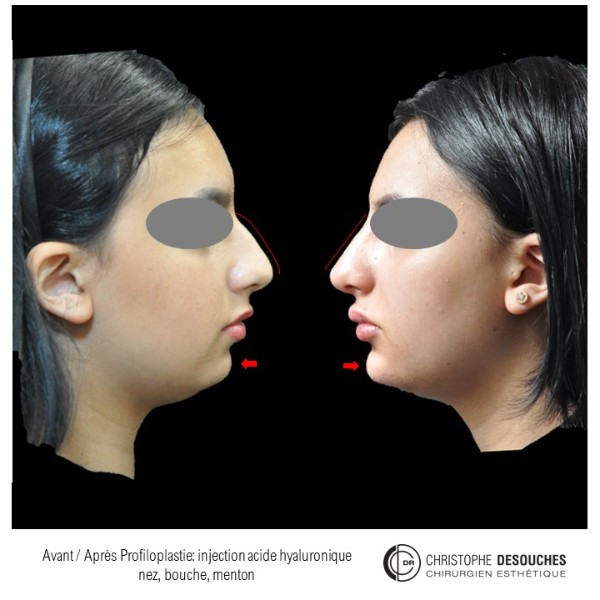 Profiloplasty by injection of hyaluronic acid