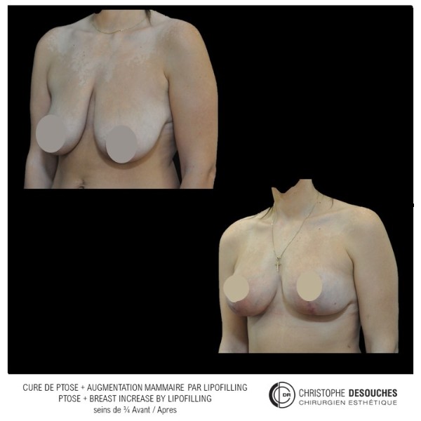 Breast ptosis and lipofilling