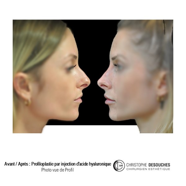 Profiloplastie l' art d'harmoniser le visage par injection d'acide hyaluronique 
